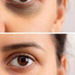 How To Remove Dark Circles Around Eyes