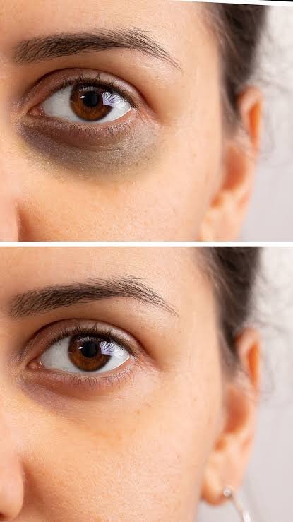 How To Remove Dark Circles Around Eyes