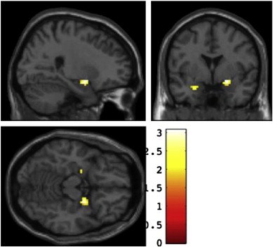 Amygdala and Emotional Sensitivity